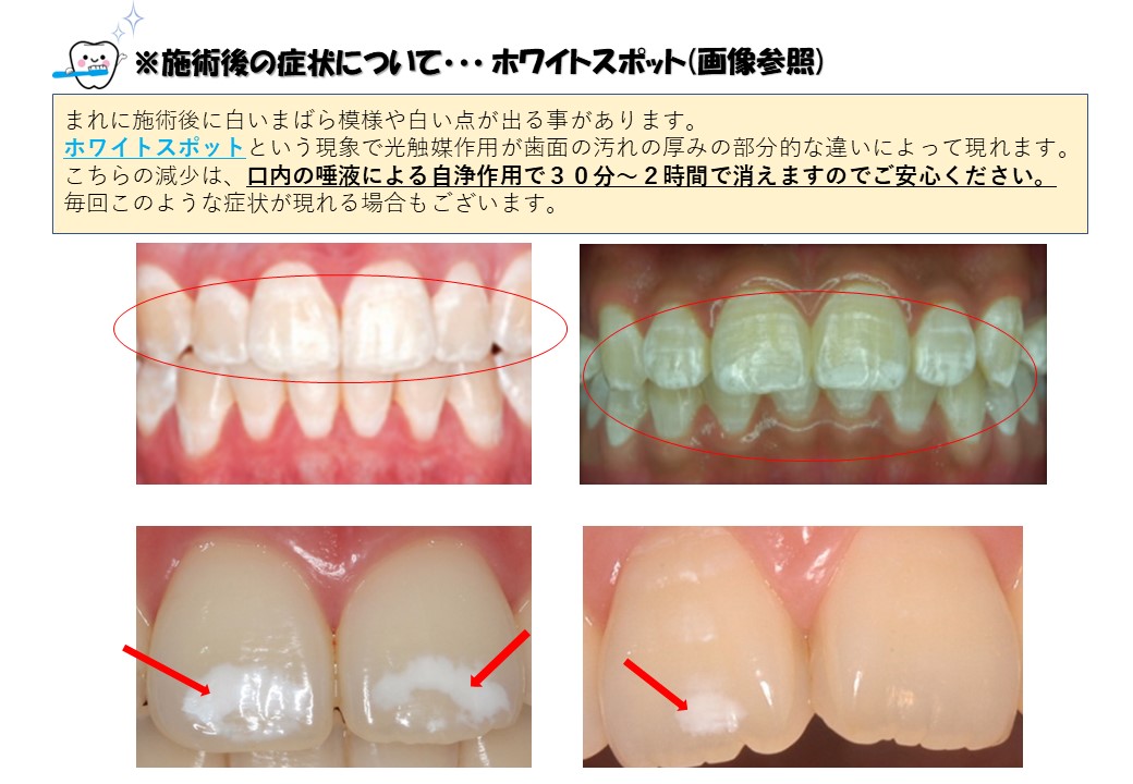 セルフホワイトニング【値下げしました】 はりつか